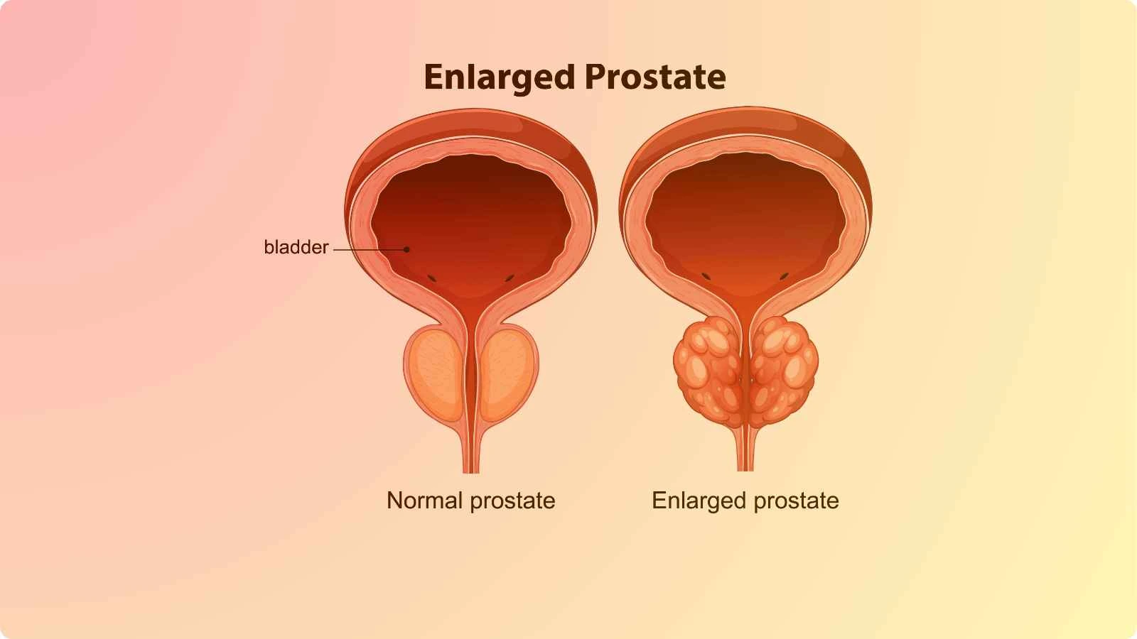 Benign Prostatic Hyperplasia